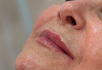 Depois do tratamento: o mesmo perfil, com os lábios mais volumosos e definidos